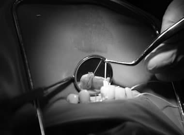 odontologia endodoncia, endodoncia dental, endodoncia unirradicular, endodoncia infectada, endodoncia en molar, endodoncia en dientes temporales