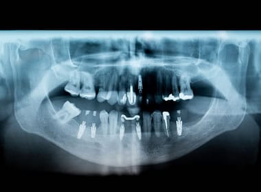 implantes dentales en colombia, implante dental colombia, implante dental en colombia, implantes bogota, procedimiento de implante dental