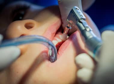 limpieza dental, profilaxis dental, limpieza dental bogota
